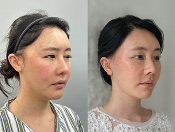 DEEP-PLANE-FACELIFT-before-after-05