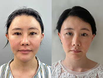 DEEP-PLANE-FACELIFT-before-after-06