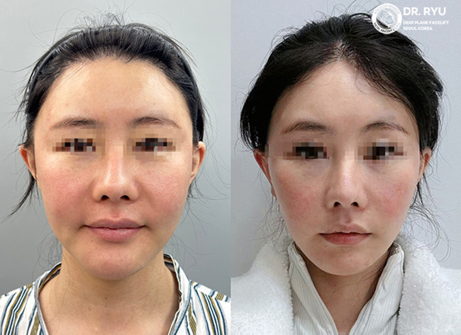 face-lift-before-and-after-young