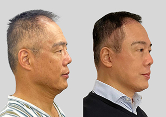 Dr-Ryus-Deep-Plane-Face-and-Neck-Lift_3-1.jpg